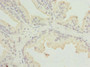 Immunohistochemistry of paraffin-embedded human prostate cancer using CAC10720 at dilution of 1:100