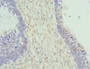 Immunohistochemistry of paraffin-embedded human ovarian cancer using CAC10724 at dilution of 1:100