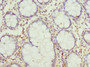 Immunohistochemistry of paraffin-embedded human colon cancer using CAC10734 at dilution of 1:100