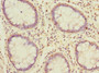 Immunohistochemistry of paraffin-embedded human colon cancer using CAC10738 at dilution of 1:100