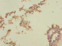 Immunohistochemistry of paraffin-embedded human breast cancer using CAC10748 at dilution of 1:100