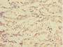 Immunohistochemistry of paraffin-embedded human gastric cancer using CAC10756 at dilution of 1:100