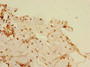 Immunohistochemistry of paraffin-embedded human breast cancer using CAC10757 at dilution of 1:100 Immunohistochemistry of paraffin-embedded human breast cancer using CAC10757 at dilution of 1:100