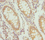 Immunohistochemistry of paraffin-embedded human colon cancer using CAC10801 at dilution of 1:100