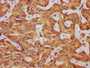 IHC image diluted at 1:325 and staining in paraffin-embedded human liver cancer performed on a Leica BondTM system. After dewaxing and hydration, antigen retrieval was mediated by high pressure in a citrate buffer (pH 6.0). Section was blocked with 10% normal goat serum 30min at RT. Then primary antibody (1% BSA) was incubated at 4°C overnight. The primary is detected by a biotinylated secondary antibody and visualized using an HRP conjugated SP system.