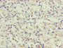 Immunohistochemistry of paraffin-embedded human gastric cancer using CAC10820 at dilution of 1:100