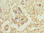 Immunohistochemistry of paraffin-embedded human pancreatic cancer using CAC10829 at dilution of 1:100