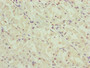 Immunohistochemistry of paraffin-embedded human gastric cancer using CAC10837 at dilution of 1:100