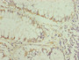 Immunohistochemistry of paraffin-embedded human colon cancer using CAC10838 at dilution of 1:100
