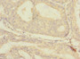 Immunohistochemistry of paraffin-embedded human endometrial cancer using CAC10842 at dilution of 1:100