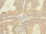 Immunohistochemistry of paraffin-embedded human endometrial cancer using CAC10847 at dilution of 1:100