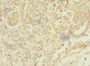 Immunohistochemistry of paraffin-embedded human pancreatic cancer using CAC10852 at dilution of 1:100
