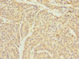 Immunohistochemistry of paraffin-embedded human ovarian cancer using CAC10859 at dilution of 1:100