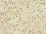 Immunohistochemistry of paraffin-embedded human glioma using CAC10864 at dilution of 1:100