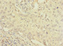 Immunohistochemistry of paraffin-embedded human lung cancer using CAC10872 at dilution of 1:100