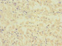 Immunohistochemistry of paraffin-embedded human gastric cancer using CAC10872 at dilution of 1:100