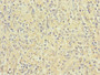 Immunohistochemistry of paraffin-embedded human lung cancer using CAC10873 at dilution of 1:100