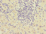 Immunohistochemistry of paraffin-embedded human liver cancer using CAC10885 at dilution of 1:100 Immunohistochemistry of paraffin-embedded human liver cancer using CAC10885 at dilution of 1:100