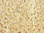 Immunohistochemistry of paraffin-embedded human melanoma using CAC10910 at dilution of 1:100