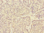Immunohistochemistry of paraffin-embedded human ovarian cancer using CAC10911 at dilution of 1:100