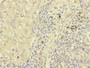 Immunohistochemistry of paraffin-embedded human liver cancer using CAC10912 at dilution of 1:100