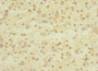 Immunohistochemistry of paraffin-embedded human glioma using CAC10913 at dilution of 1:100