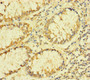 Immunohistochemistry of paraffin-embedded human colon cancer using CAC10931 at dilution of 1:100