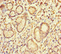 Immunohistochemistry of paraffin-embedded human gastric cancer using CAC10933 at dilution of 1:100
