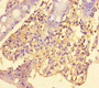 Immunohistochemistry of paraffin-embedded human colon cancer using CAC10938 at dilution of 1:100