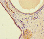 Immunohistochemistry of paraffin-embedded human prostate cancer using CAC10945 at dilution of 1:100