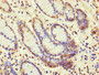 Immunohistochemistry of paraffin-embedded human gastric cancer using CAC10948 at dilution of 1:100