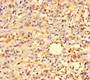 Immunohistochemistry of paraffin-embedded human gastric cancer using CAC10958 at dilution of 1:100