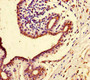 Immunohistochemistry of paraffin-embedded human breast cancer using CAC10958 at dilution of 1:100