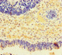 Immunohistochemistry of paraffin-embedded human ovarian cancer using CAC10960 at dilution of 1:100