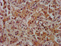 IHC image diluted at 1:1000 and staining in paraffin-embedded human liver cancer performed on a Leica BondTM system. After dewaxing and hydration, antigen retrieval was mediated by high pressure in a citrate buffer (pH 6.0). Section was blocked with 10% normal goat serum 30min at RT. Then primary antibody (1% BSA) was incubated at 4°C overnight. The primary is detected by a biotinylated secondary antibody and visualized using an HRP conjugated SP system.
