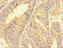 Immunohistochemistry of paraffin-embedded human endometrial cancer using CAC10976 at dilution of 1:100