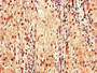 Immunohistochemistry of paraffin-embedded human liver cancer using CAC10978 at dilution of 1:100