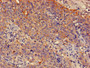 Immunohistochemistry of paraffin-embedded human cervical cancer using CAC10998 at dilution of 1:100