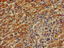 Immunohistochemistry of paraffin-embedded human liver cancer using CAC11054 at dilution of 1:100 Immunohistochemistry of paraffin-embedded human liver cancer using CAC11054 at dilution of 1:100