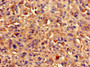 Immunohistochemistry of paraffin-embedded human melanoma using CAC11095 at dilution of 1:100