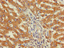Immunohistochemistry of paraffin-embedded human liver cancer using CAC11120 at dilution of 1:100