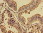 Immunohistochemistry of paraffin-embedded human endometrial cancer using CAC11134 at dilution of 1:100
