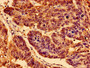 Immunohistochemistry of paraffin-embedded human gastric cancer using CAC11161 at dilution of 1:100 Immunohistochemistry of paraffin-embedded human gastric cancer using CAC11161 at dilution of 1:100