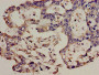 Immunohistochemistry analysis of human pancreatic cancer using CAC11163 at dilution of 1:100