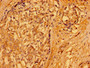 Immunohistochemistry of paraffin-embedded human breast cancer using CAC11171 at dilution of 1:100