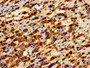 Immunohistochemistry of paraffin-embedded human liver cancer using CAC11186 at dilution of 1:100 Immunohistochemistry of paraffin-embedded human liver cancer using CAC11186 at dilution of 1:100