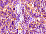 Immunohistochemistry of paraffin-embedded human pancreatic cancer using CAC11189 at dilution of 1:100 Immunohistochemistry of paraffin-embedded human pancreatic cancer using CAC11189 at dilution of 1:100