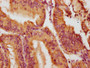 IHC image diluted at 1:100 and staining in paraffin-embedded human endometrial cancer performed on a Leica BondTM system. After dewaxing and hydration, antigen retrieval was mediated by high pressure in a citrate buffer (pH 6.0). Section was blocked with 10% normal goat serum 30min at RT. Then primary antibody (1% BSA) was incubated at 4°C overnight. The primary is detected by a biotinylated secondary antibody and visualized using an HRP conjugated SP system. IHC image diluted at 1:100 and staining in paraffin-embedded human endometrial cancer performed on a Leica BondTM system. After dewaxing and hydration, antigen retrieval was mediated by high pressure in a citrate buffer (pH 6.0). Section was blocked with 10% normal goat serum 30min at RT. Then primary antibody (1% BSA) was incubated at 4°C overnight. The primary is detected by a biotinylated secondary antibody and visualized using an HRP conjugated SP system.