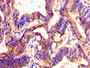Immunohistochemistry of paraffin-embedded human colon cancer using CAC11201 at dilution of 1:100 Immunohistochemistry of paraffin-embedded human colon cancer using CAC11201 at dilution of 1:100