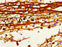 Immunohistochemistry of paraffin-embedded human melanoma using CAC11208 at dilution of 1:100 Immunohistochemistry of paraffin-embedded human melanoma using CAC11208 at dilution of 1:100